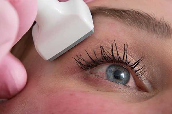 Kvinna som får microneedling behandling i ansiktet